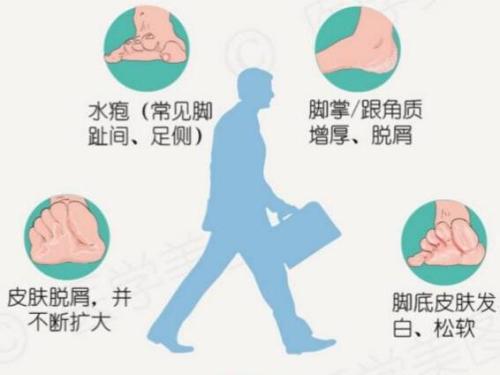 引起脚肿痛的原因有哪些,脚痒一定要警惕