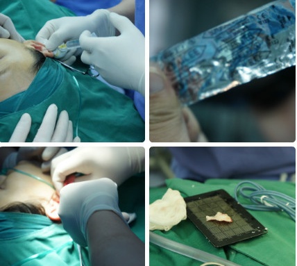 假体隆鼻能保持多久来了解一下,龚忠华整形