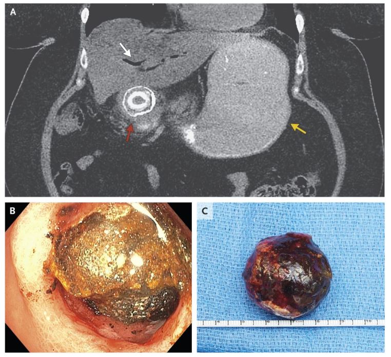 alport综合征病例分析,典型病例poland综合征