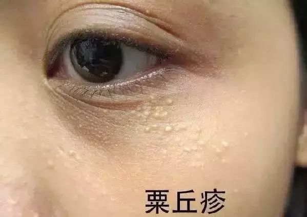 为什么脸上总反反复复长脂肪粒,脂肪粒反反复复怎么办