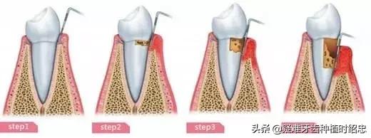 牙周炎牙齿松动要拔掉吗,牙周炎引起牙齿松动严重需要拔吗