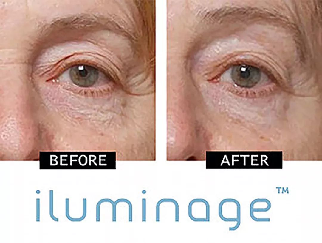 警惕你的脱发可能与它有关,脱发后变老变丑