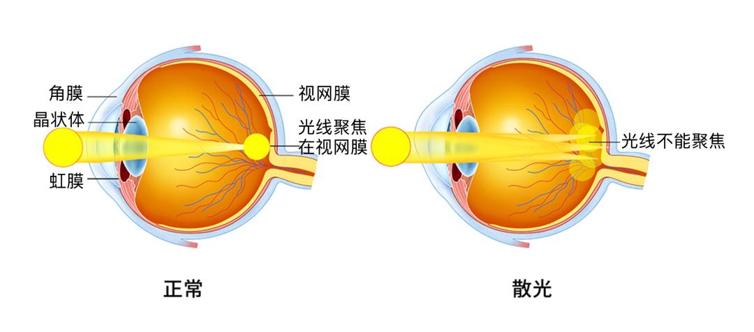 为什么很多近视的人都有散光,为什么有人近视散光