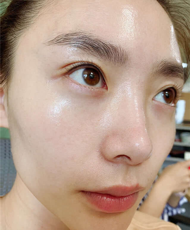 下巴反复长闭口粉刺怎么彻底去除,下巴长闭口粉刺的正确消除方法