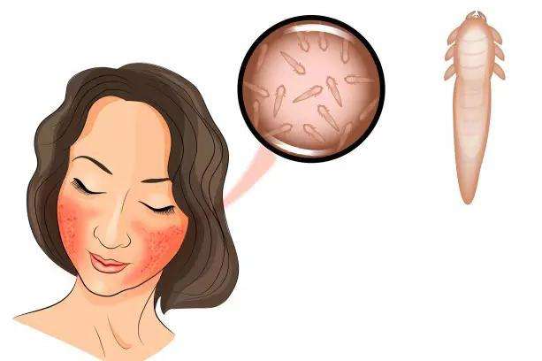 螨虫痘如何去除最高效,如何有效除螨虫痘