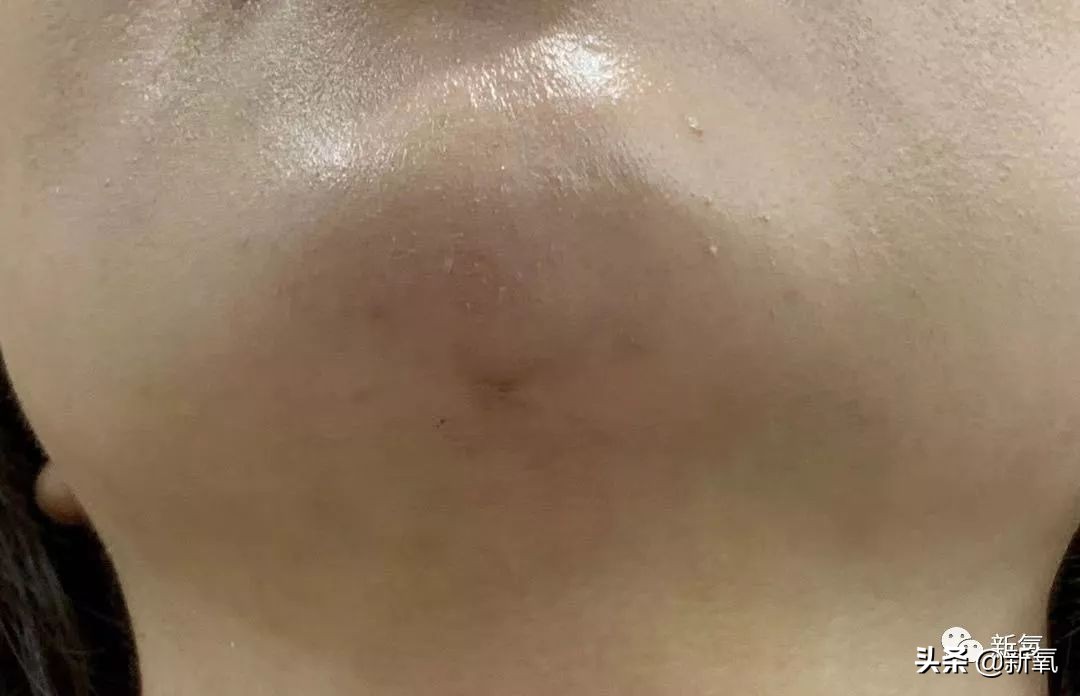 迷死氧亲身体验，我在日本吸掉了一桶脂肪和半张脸