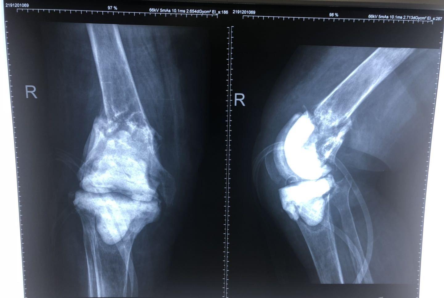 膝关节结核，是由结核杆菌引起的，主要临床表现是单侧关节发病