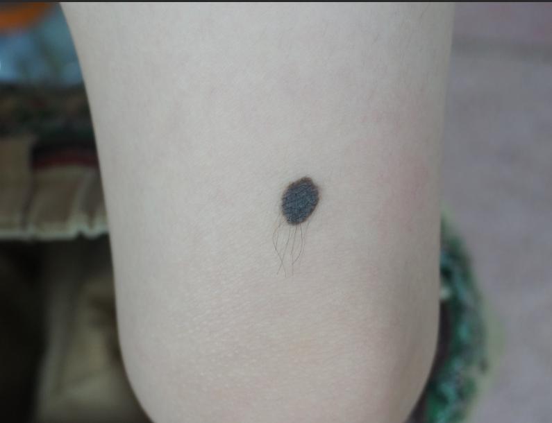 兽皮痣还有救吗？应该采取什么样子的措施才行