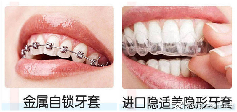 矫正牙齿戴牙套好还是隐形牙套好,牙齿矫正用隐形牙套还是传统牙套