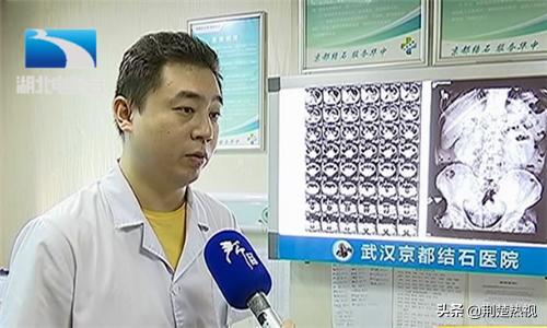 男27岁肾结石并积水经常腰疼背疼,男性轻度肾积水尿频尿急尿不尽