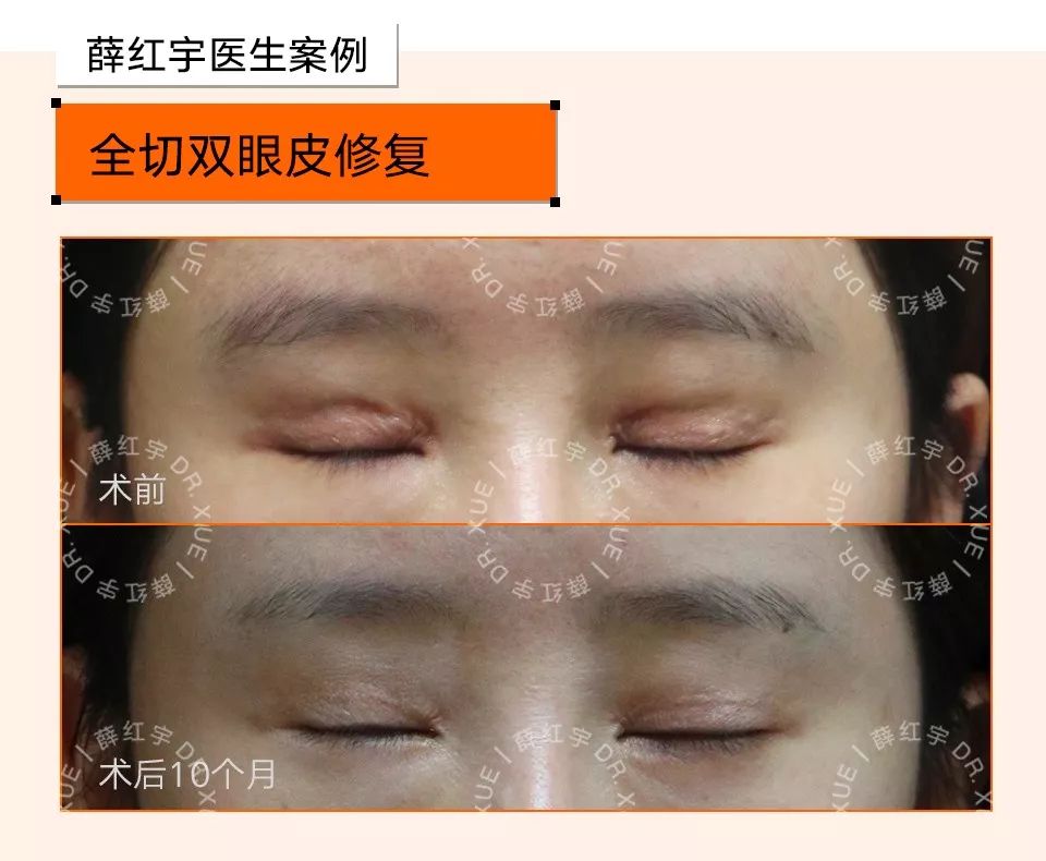 双眼皮整形修复,潘贰双眼皮修复