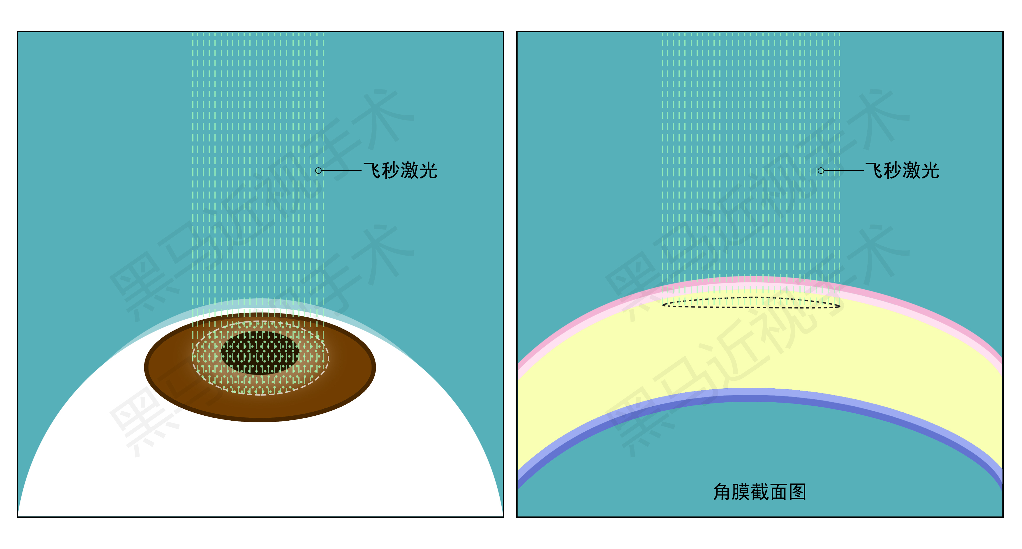 激光近视矫正手术有什么后遗症,激光治疗近视安全啊有没有后遗症