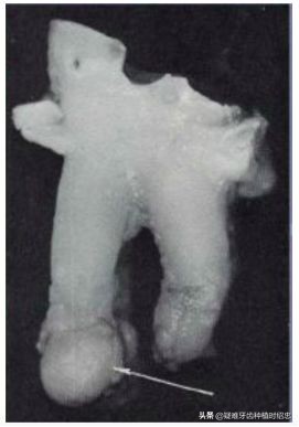 只剩残根的牙真的能补救吗,烂的只剩下黑色残根的牙怎么处理