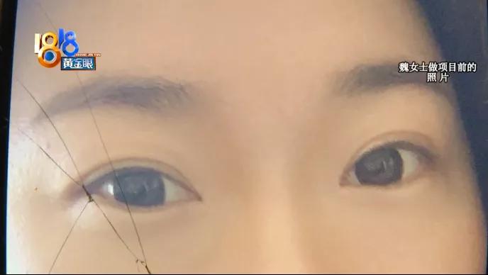 美瞳上有黑线正常吗,美瞳线做完有红血丝怎么回事