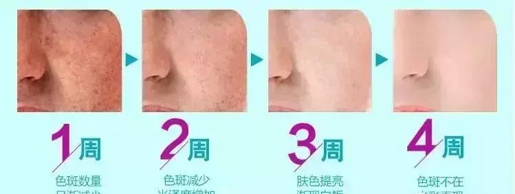 褐斑是什么样子的图片,褐斑是不是黄褐斑