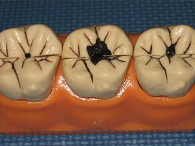 我的牙齿没了就剩牙根了怎么办,我的牙齿掉了一半里面空了怎么办