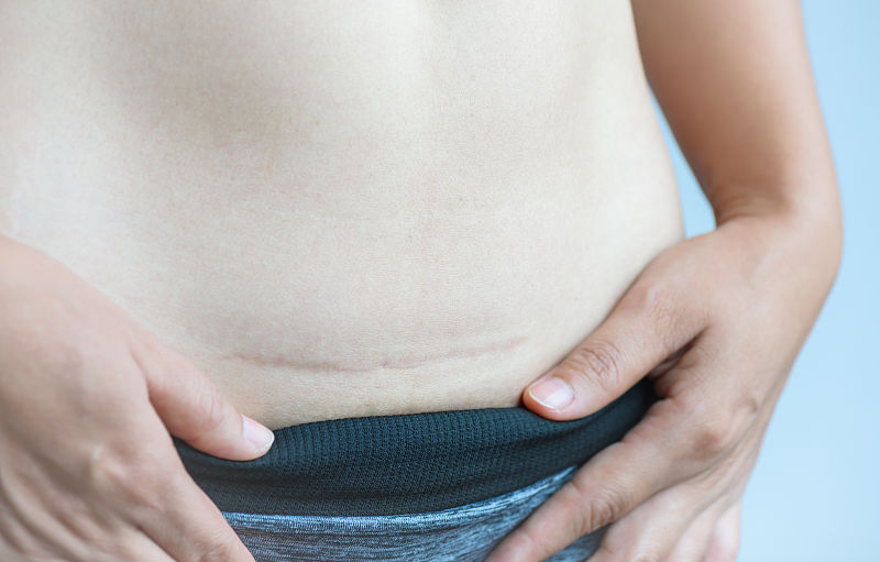 剖宫产比顺产瘦得快吗,剖宫产比顺产安全