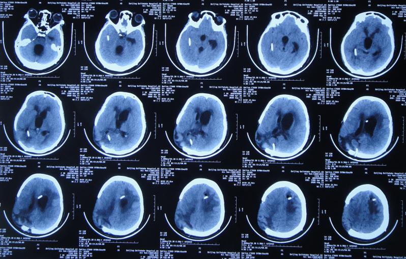 脑室有粘连脑积水有什么办法,脑动脉畸形手术后出现急性脑积水