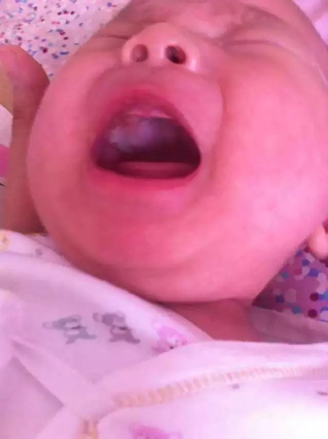 一个月的宝宝鹅口疮怎么治,宝宝鹅口疮怎么反反复复