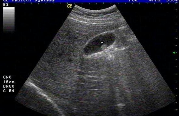 胆囊炎的症状饮食和注意事项,胆囊炎的症状与饮食和治疗