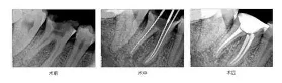 牙齿折断不及时治疗会怎样,牙齿折断了只剩根部