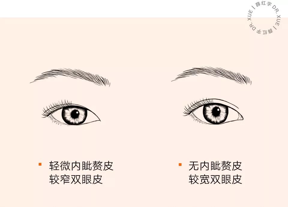 从美术角度谈眯眯眼,开内眼角传统术式