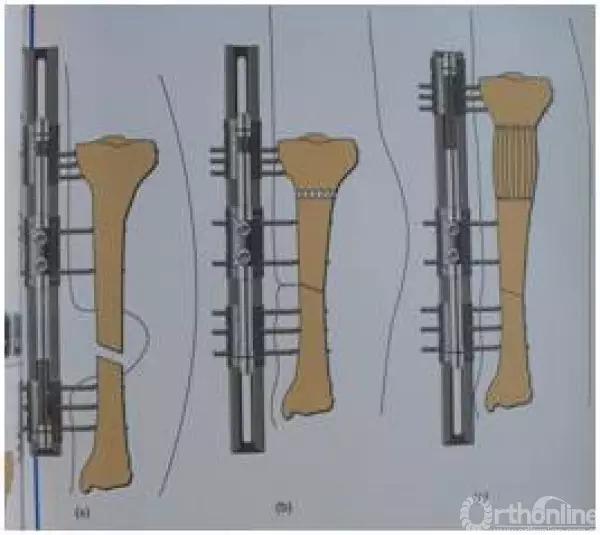 外固定支架训练方法,外固定支架拆除后怎么护理