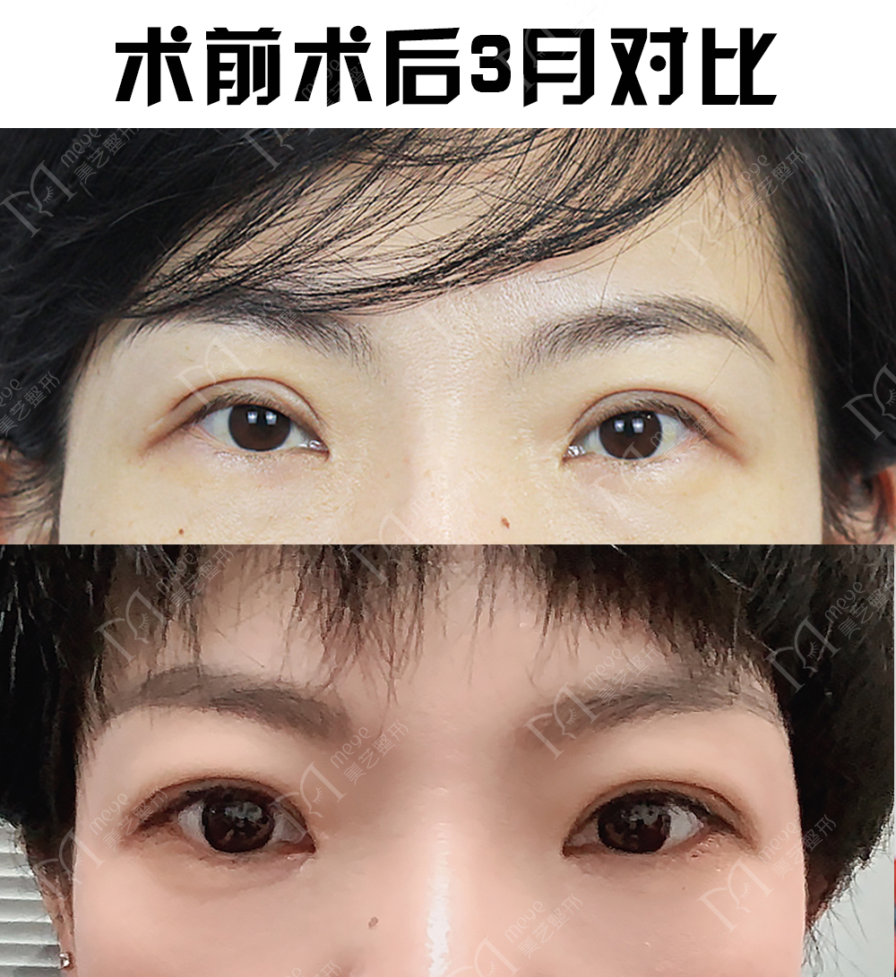 双眼皮术后出现肉条怎么办,双眼皮肉条感修复手术痛吗