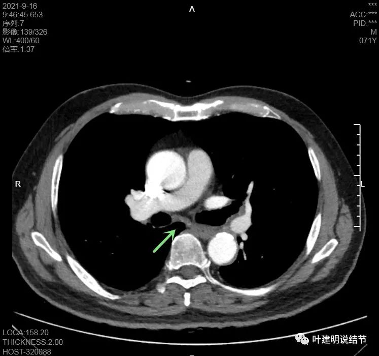 肺上有实性结节6mmx5mm是什么原因,肺上有1.7x1.8的实性结节该怎么办