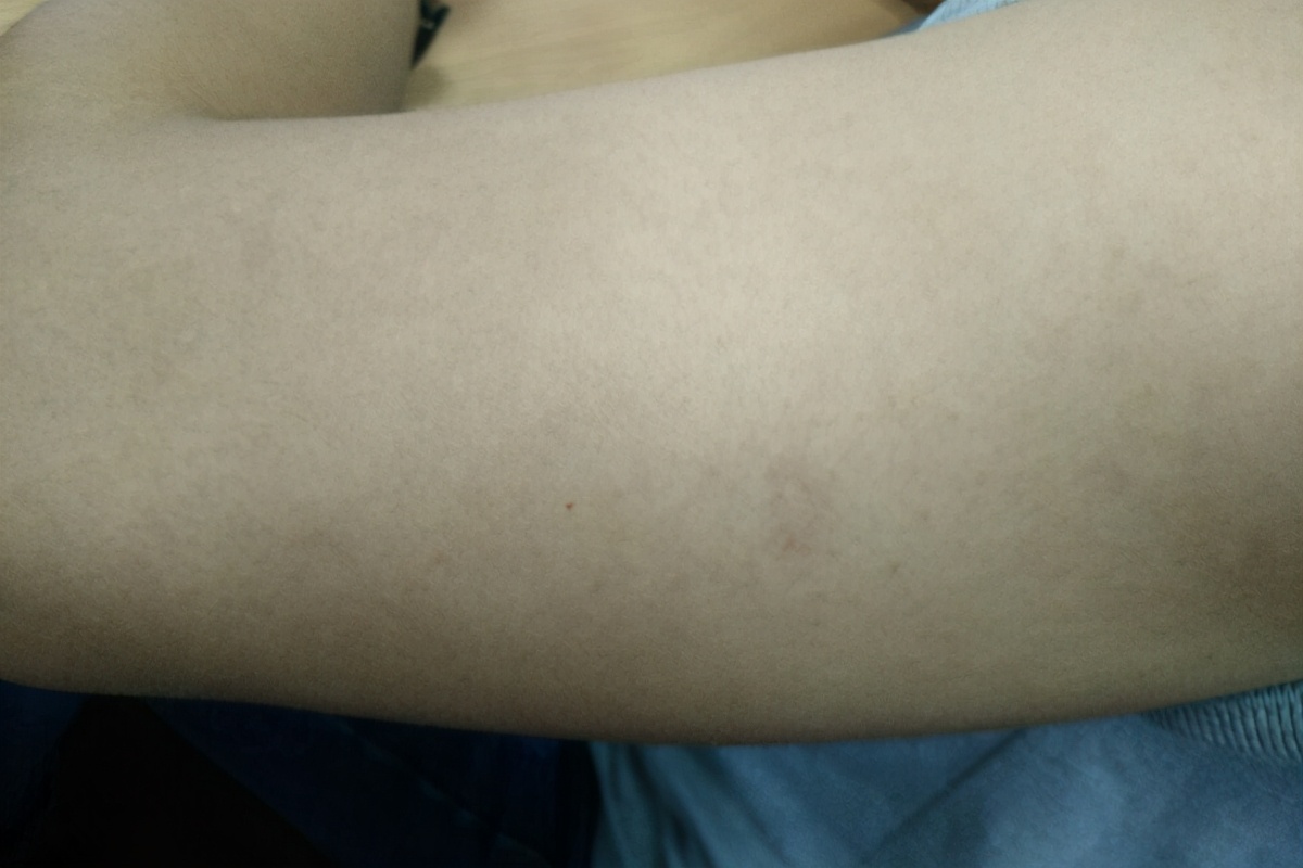 女孩油皮换季脸部起皮泛红,脸部干燥起皮屑是什么原因