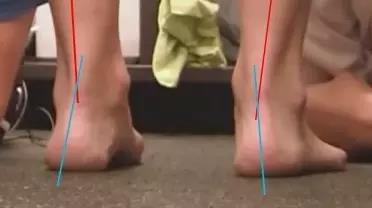 扁平足的危害怎么形成的,扁平足的危害和治疗方法