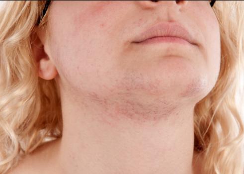 激素药膏用了脸会变黑吗,激素药膏涂了脸上会怎样