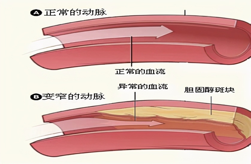 胆固醇要查什么才可以知道,胆固醇有一点点偏高医生没有开药