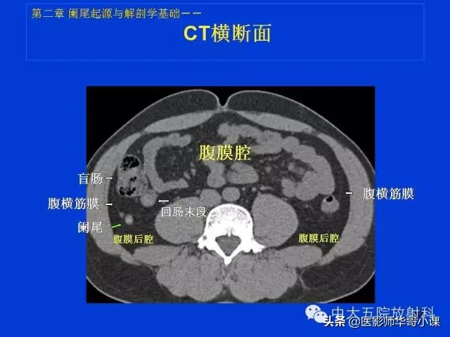 阑尾炎课件,阑尾炎的超声课件