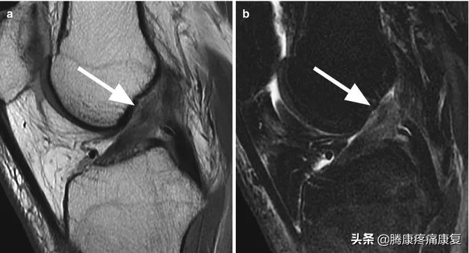 前交叉韧带断裂半月板后角撕裂,左膝前交叉韧带部分撕裂怎么办