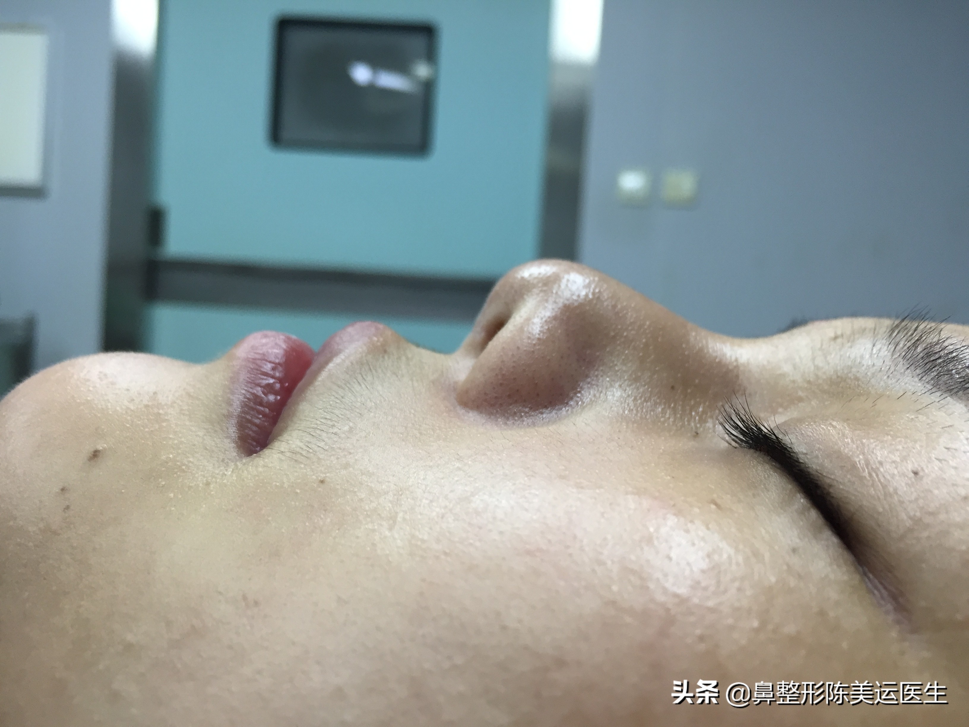 为什么医生都反对线雕隆鼻,到底要不要做线雕隆鼻