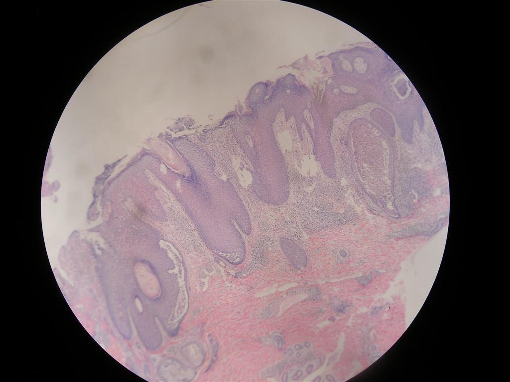 化脓性汗腺炎是什么引起的,化脓性汗腺炎是怎么引起的