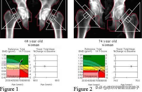 女性更年期骨痛会自然消吗,更年期全身骨痛怎么治