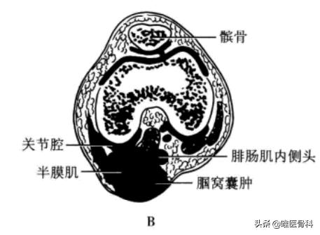 膝盖后面有个鼓鼓的包是不是病,膝盖后面有个包怎么回事