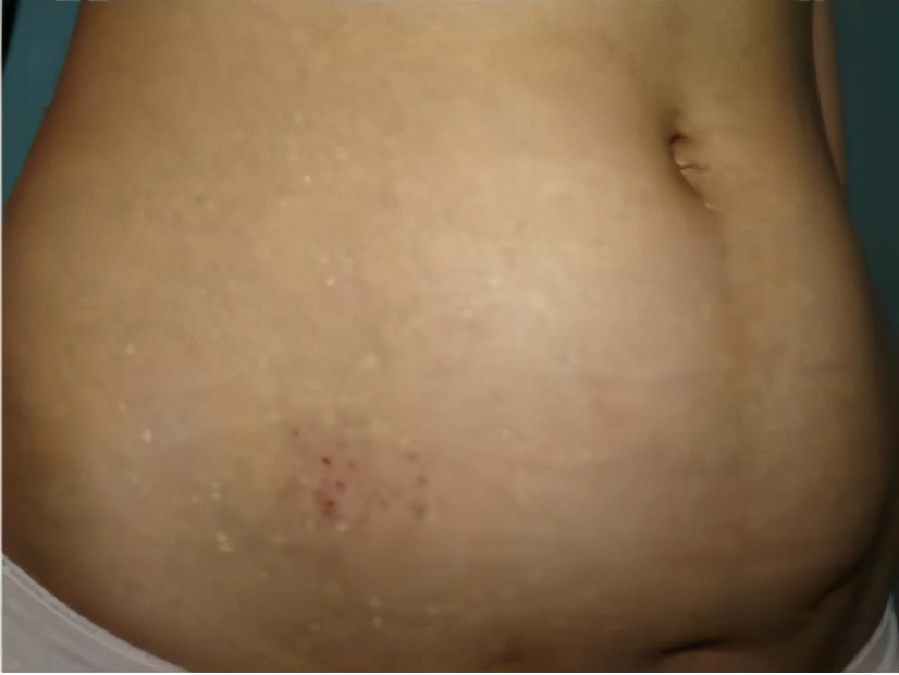 白斑是白癜风还是糠疹如何鉴别呢,宝宝脸上有白斑是脾胃虚吗