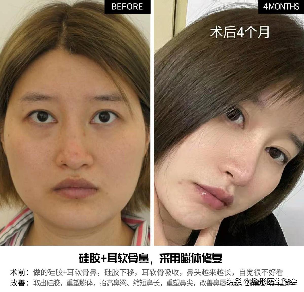 为什么耳软骨只能垫鼻尖不能隆鼻,肋软骨隆鼻时间久了会顶破鼻尖吗