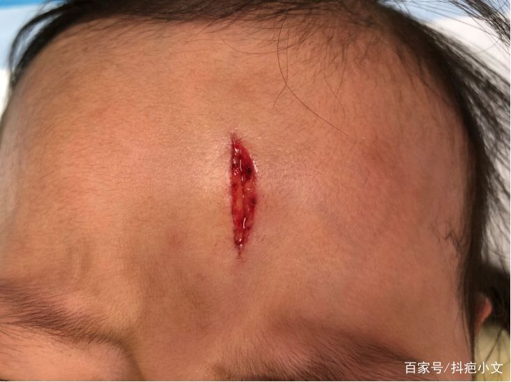 小孩经常受伤怎么办,孩子不小心受伤情况有哪些