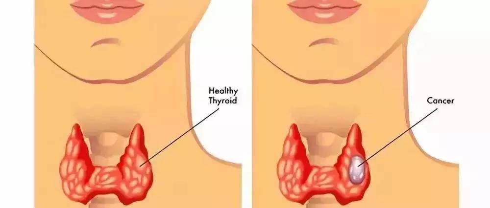 息肉囊肿结节和肌瘤的区别,结节息肉囊肿哪个容易癌变