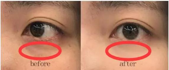 去眼纹去黑眼圈用什么方法,去眼袋黑公认最好用的土方法