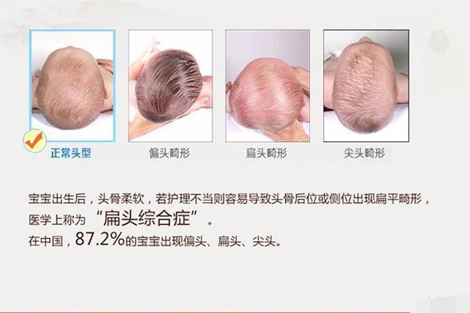 新生儿头型偏长如何睡圆,青年扁头可以通过睡姿矫正吗