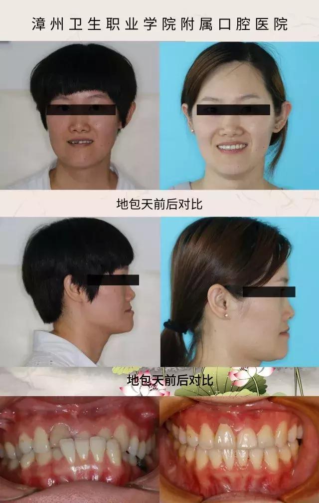 小朋友牙齿地包天矫正方法,牙齿地包天多大矫正最合适