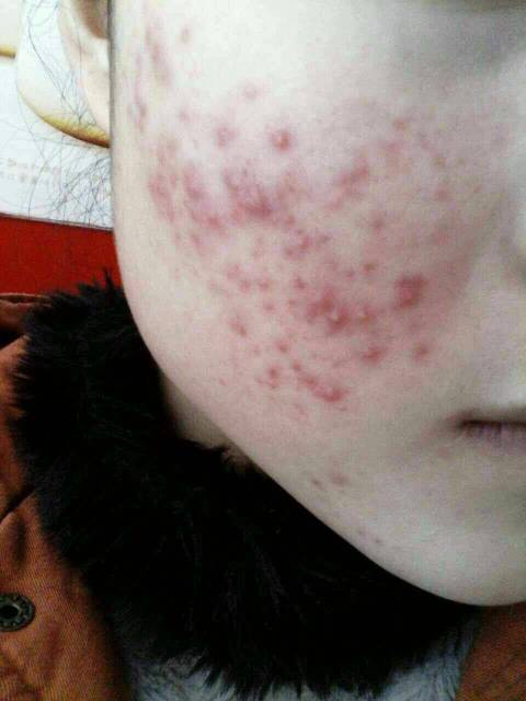 30岁长痘的原因,30岁脸上反复长痘去医院看什么科