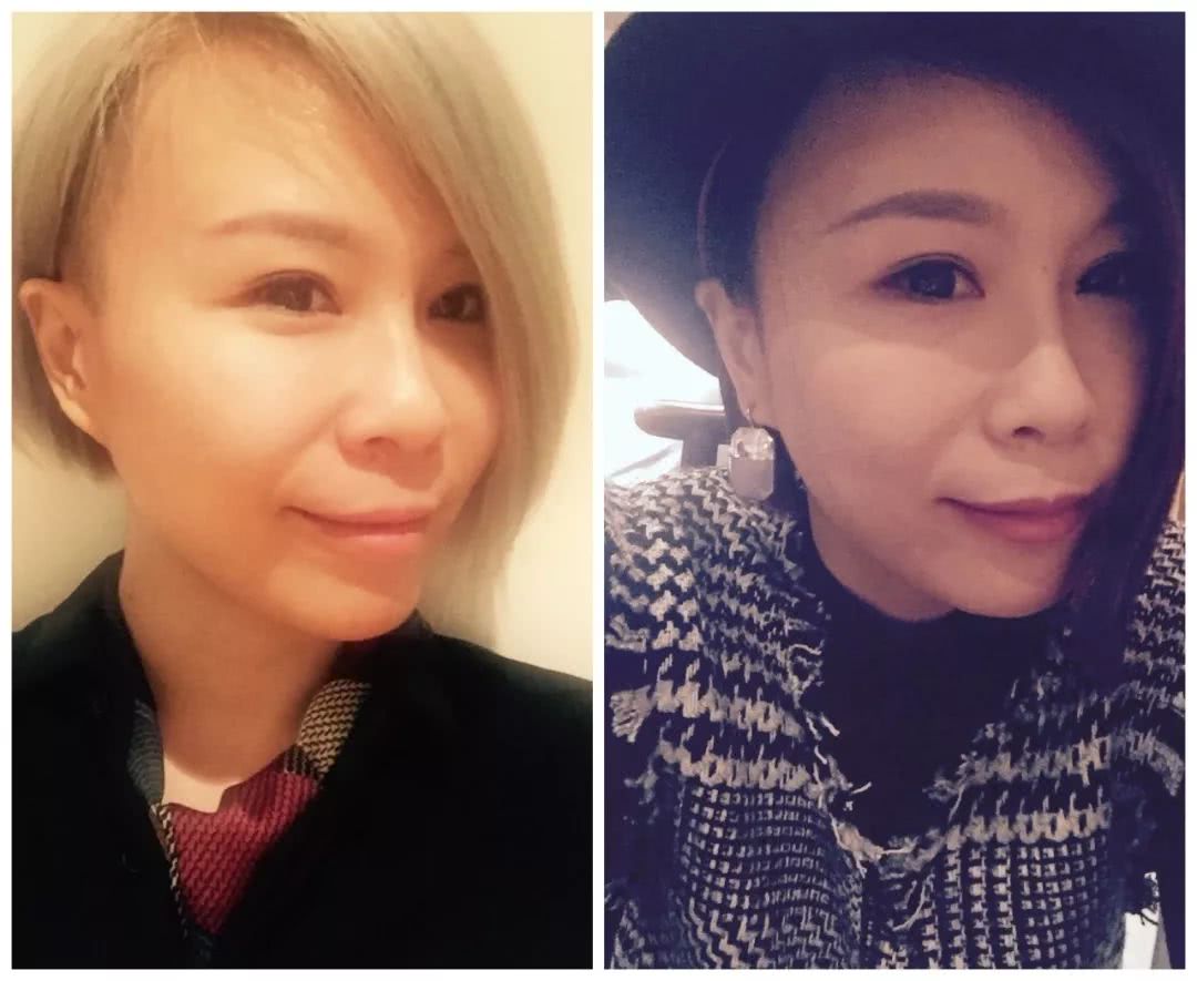 微整的真实效果,微整蜕变过程