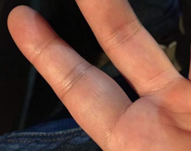 手指腱鞘炎怎么治好得快,手指腱鞘炎怎么办最快最有效