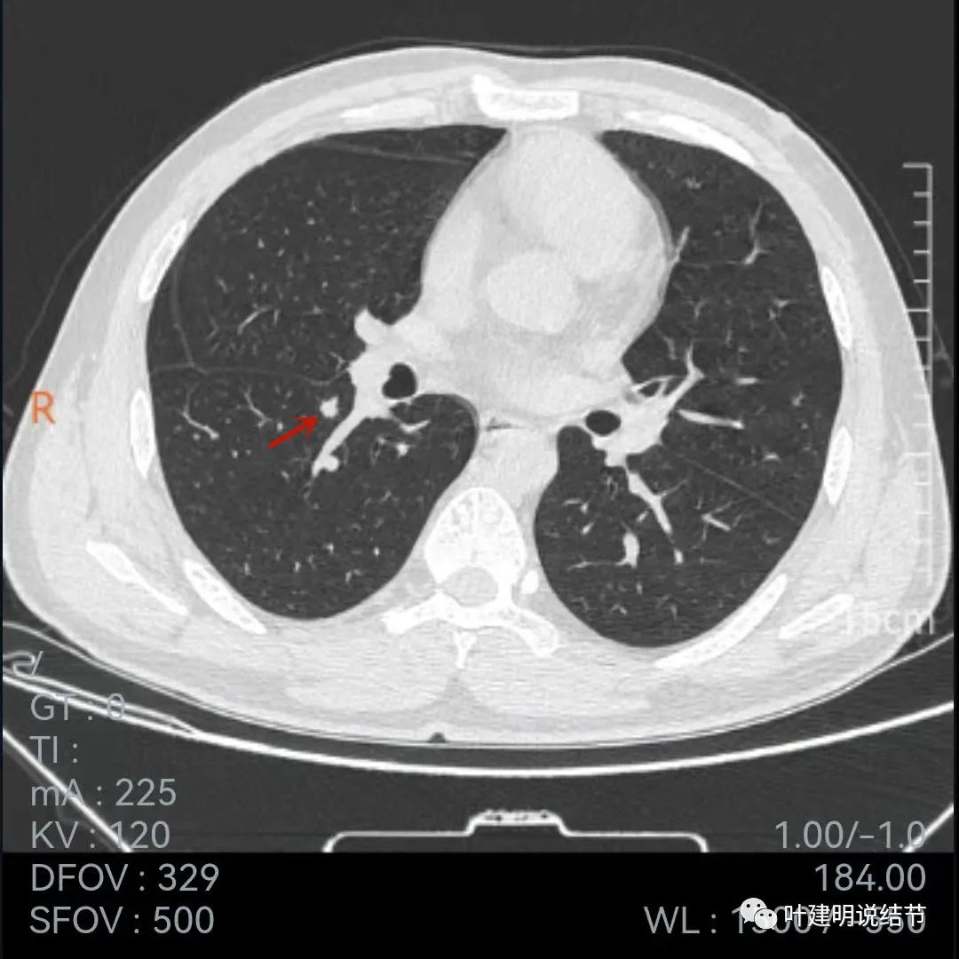 问诊分析:存在了4年的实性结节会不会是肺癌?